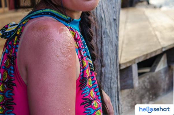 Atasi Erythropoietic Protoporphyria: Panduan Lengkap Gejala & Pengobatan