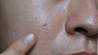 Rahasia Kulit Glowing? Atasi Masalah Sel Kulit Mati Sekarang!